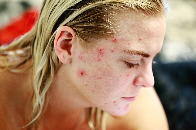 Acne Treatment Like Proactive